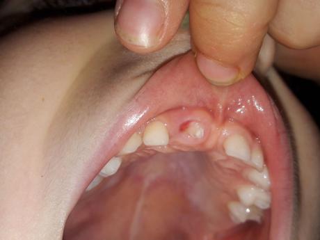 Une dent peut en cacher une autre